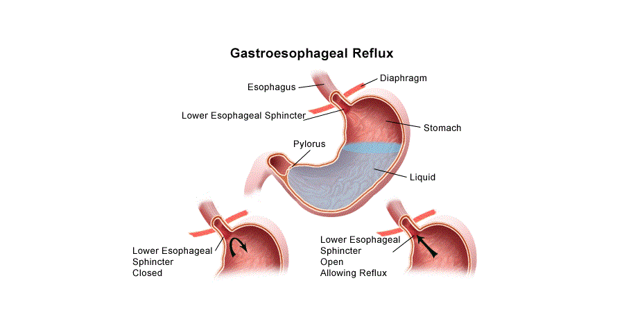 Reflux bij een baby wordt veroorzaakt door een nog onvoldoende ontwikkelde sluitspier